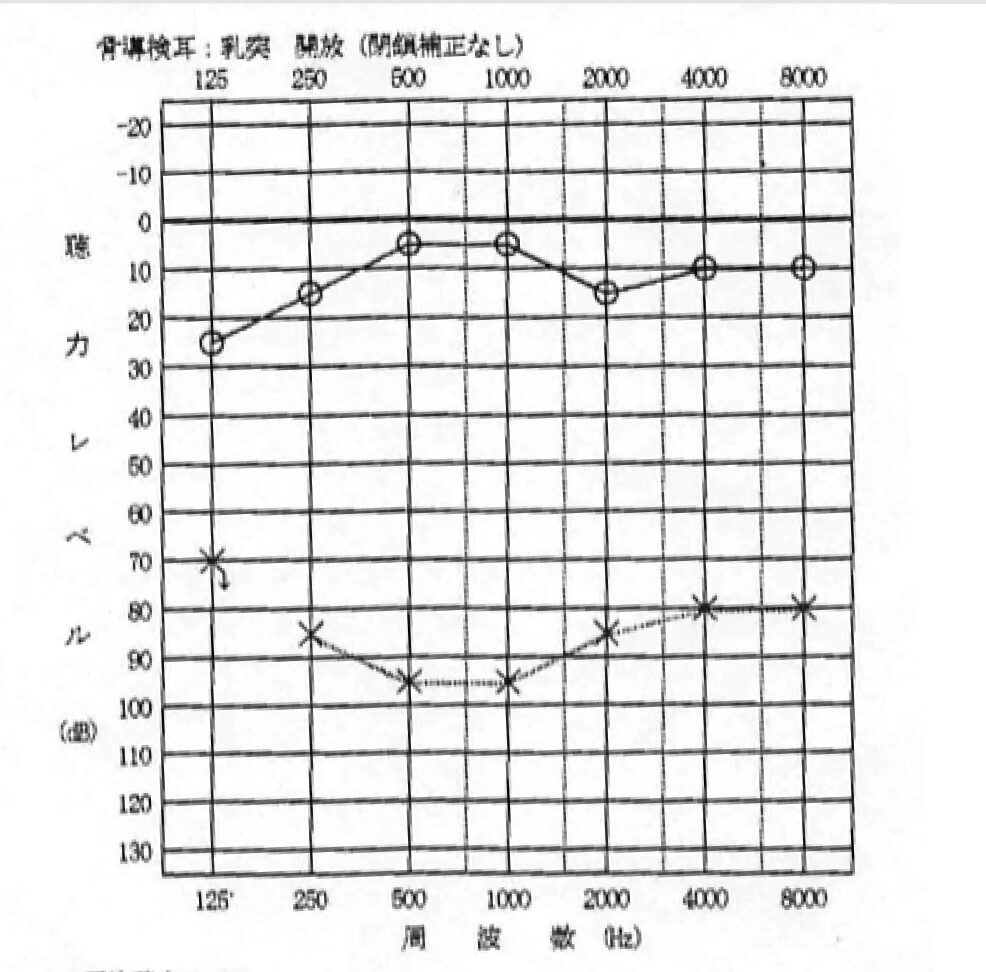 突発性難聴：治療前のオージオグラム（左耳は高音域で閾値上昇、右耳は正常域）