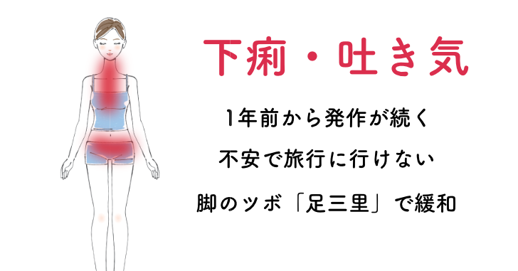 突然の下痢・吐き気で旅行が不安だった40代女性の症例。足三里・承山への少数鍼で安定した経過